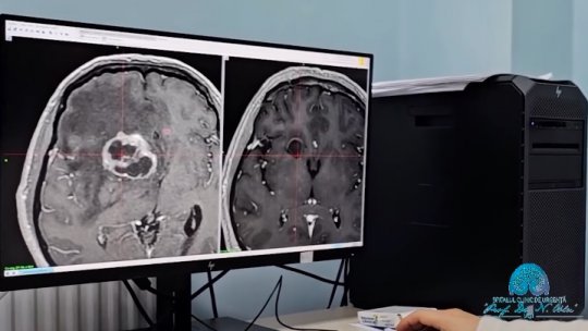 IAȘI: Pacient cu tumoră pe creier, tratat fără operație | VIDEO