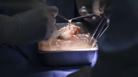 SUA: A murit pacientul căruia îi fusese transplantat un rinichi de porc