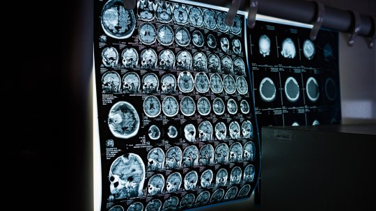 Studiu: Densitatea osoasă scăzută ar putea fi asociată cu declinul cognitiv